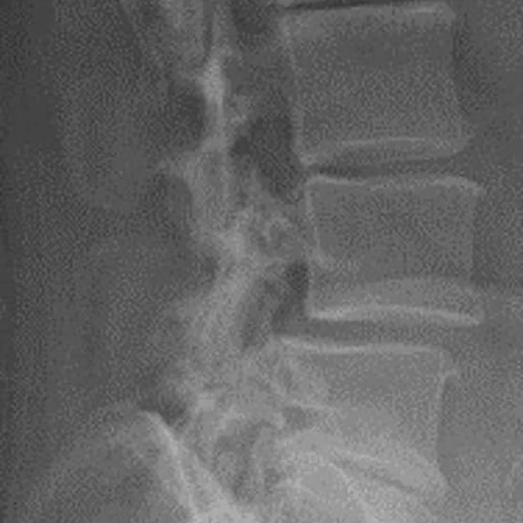 Radiografia da coluna lombar